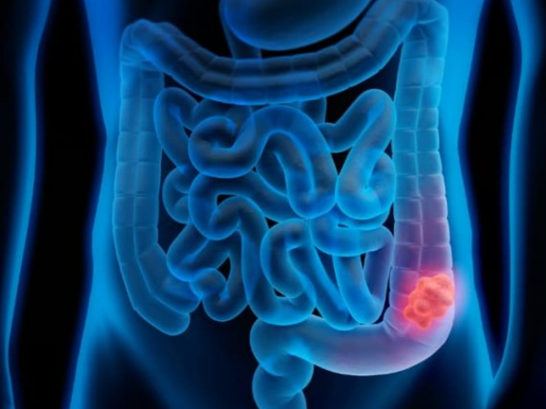 Cáncer de colon. Foto referencial.