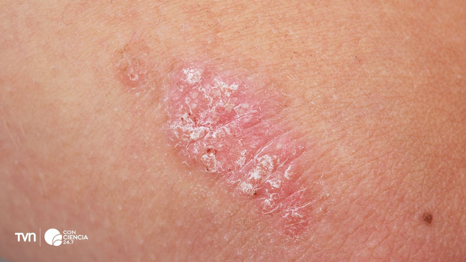 Piel durante un proceso inflamatorio asociado a la psoriasis.