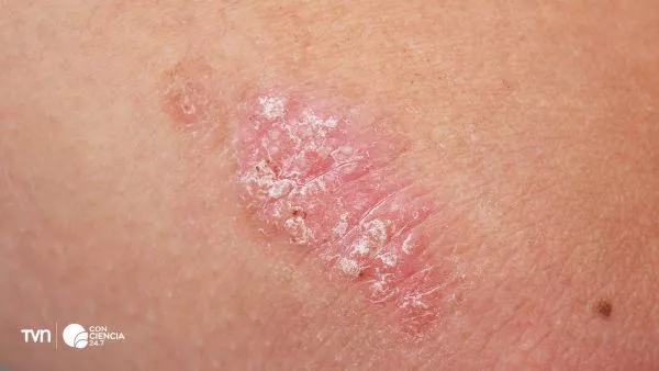 Piel durante un proceso inflamatorio asociado a la psoriasis.