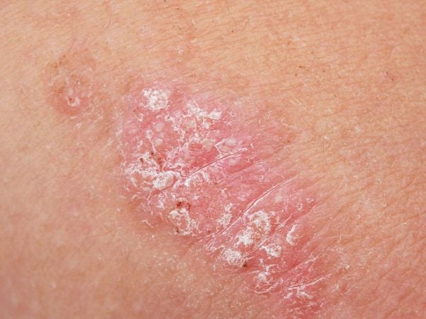 Piel durante un proceso inflamatorio asociado a la psoriasis.