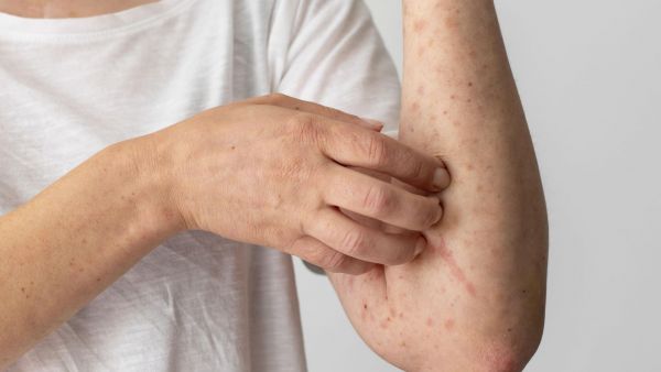 Sarampión en Chile, imagen referencial