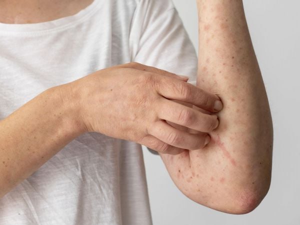 Sarampión en Chile, imagen referencial