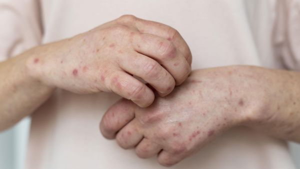 Contado de sarampión en La Araucanía