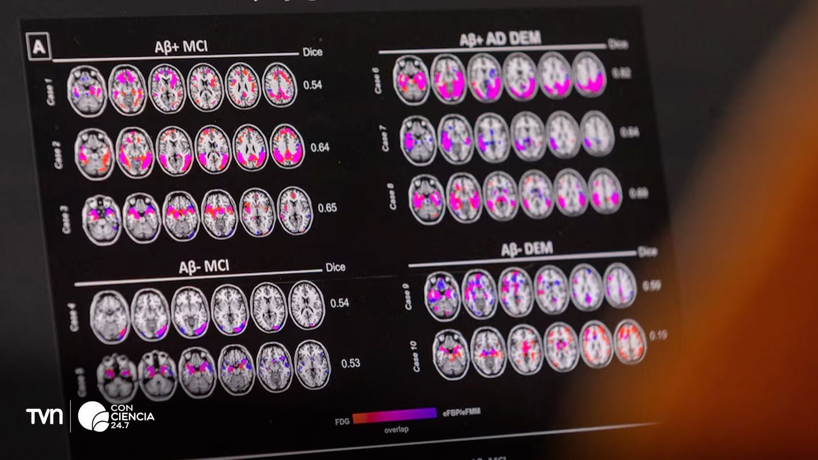 Radiografías del cerebro de personas con Alzheimer.