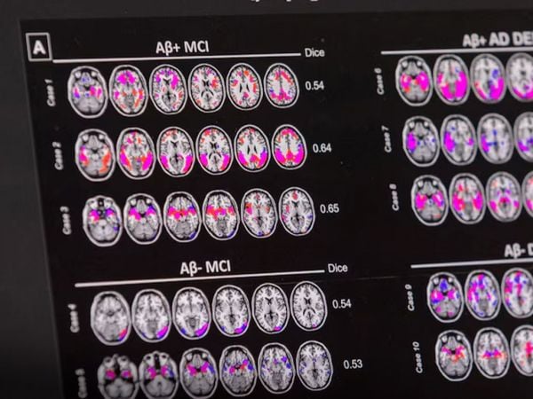 Radiografías del cerebro de personas con Alzheimer.