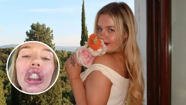 Influencer se vuelve viral luego de mostrar el resultado de su relleno de labios