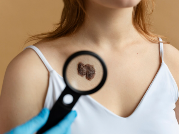 Los 3 tipos de cáncer de piel: Cómo detectarlos y tratamiento