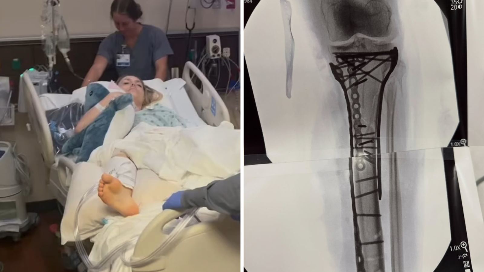 Lindsey Vonn internada y las prótesis que le debieron colocar en la pierna lesionada