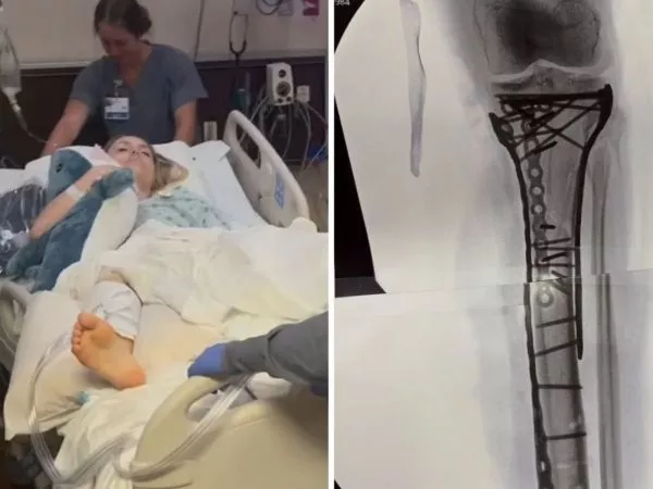 Lindsey Vonn internada y las prótesis que le debieron colocar en la pierna lesionada