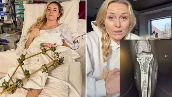 Lindsey Vonn contando sobre la compleja lesión que sufrió en los Juegos Olímpicos