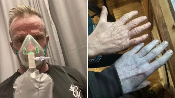 Tommy Lynch mostrando cómo quedó azul tras despertar