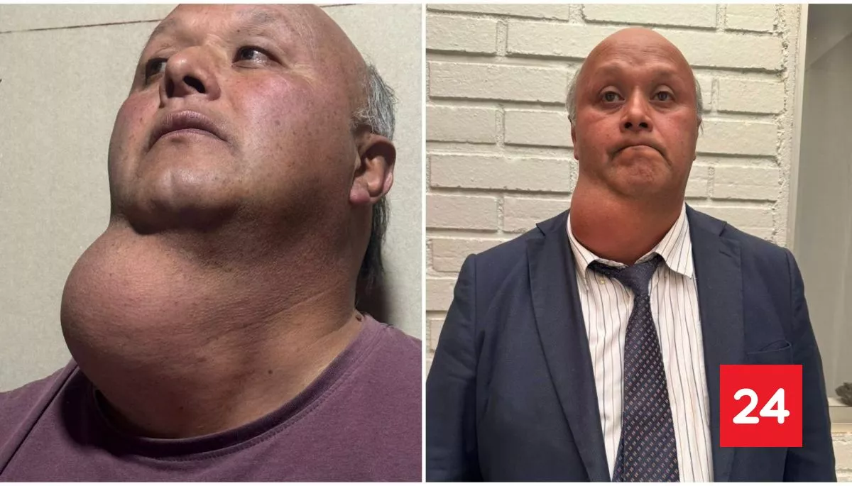 Esperó 17 años: hombre de Victoria que vive con gran bulto en el cuello será operado