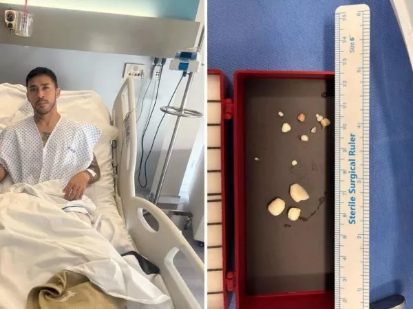 Edson puch tras su operación de tobillo y los fragmentos que le retiraron de este