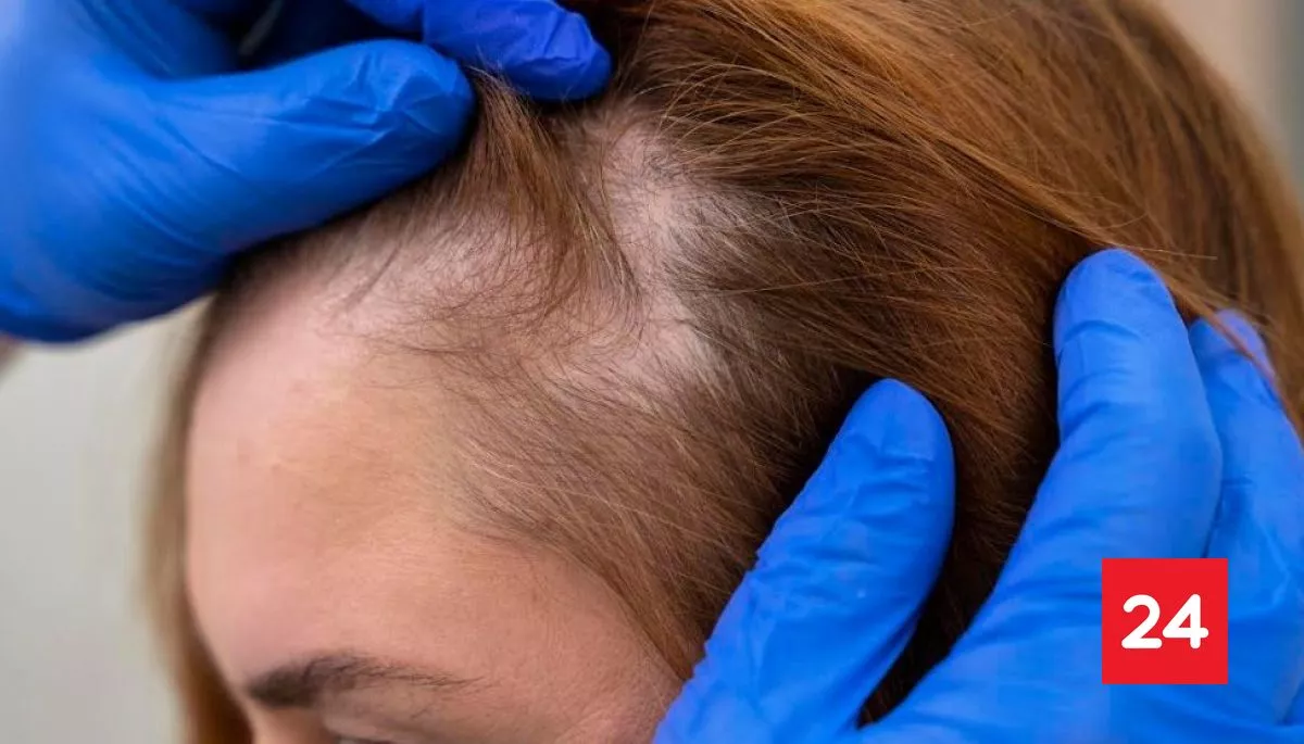 Inteligencia Artificial para la alopecia: ciencia de datos y biología molecular para frenar caída del cabello
