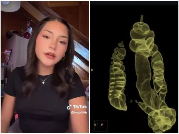 Adolescente con enfermedad de Hirschsprung necesita $50 millones para importante cirugía