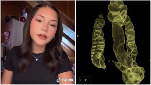 Adolescente con enfermedad de Hirschsprung necesita $50 millones para importante cirugía