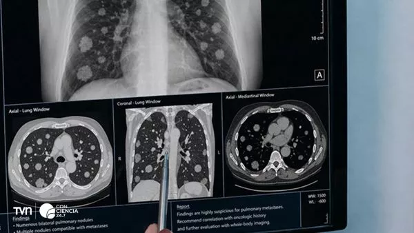 Base de datos con IA mejora seguimiento del cáncer en Chile.