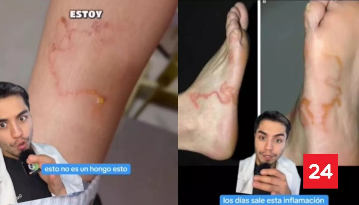 #Bienestar

“Nuevo miedo desbloqueado”: Dermatólogo revela el gusano que podría vivir en tu piel sin que lo notes

Más detalles⬇️