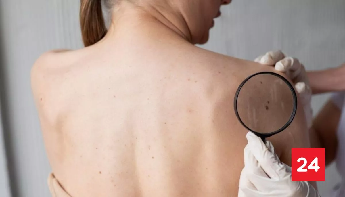 ¿Cuándo preocuparse por un lunar?: Las señales de alerta del cáncer de piel más peligroso