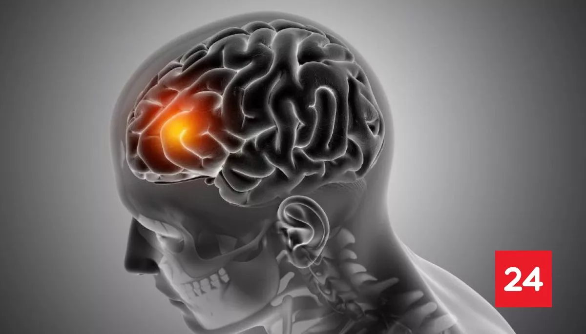 #Bienestar 

Tumor cerebral: las señales "típicas" que podrí