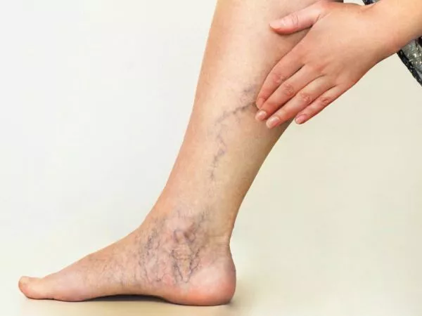 Persona con várices en sus piernas