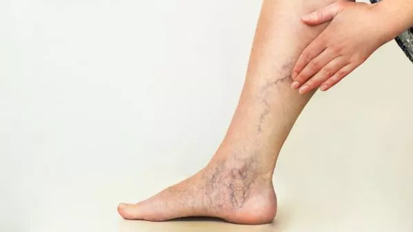 Persona con várices en sus piernas