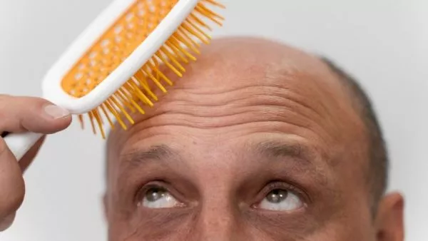 El profundo impacto de la calvicie en la salud mental de los hombres