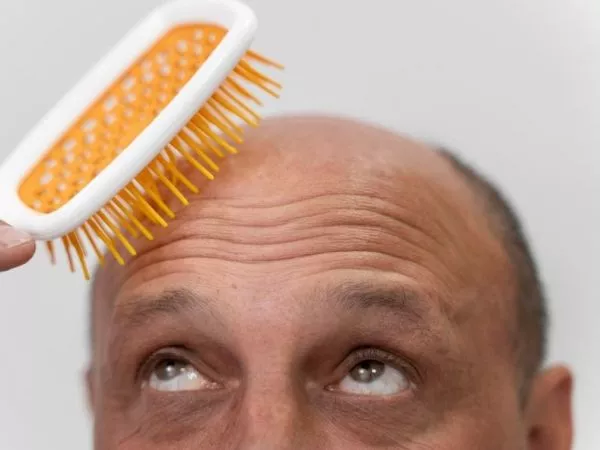 El profundo impacto de la calvicie en la salud mental de los hombres