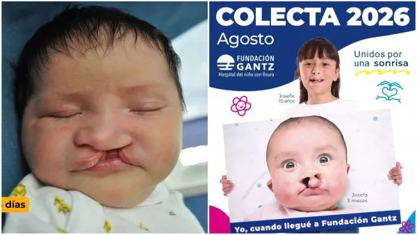 Colecta Fundación Gantz 2026: cómo donar para ayudar a niños con fisura labiopalatina