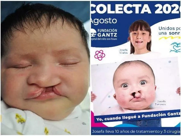 Colecta Fundación Gantz 2026: cómo donar para ayudar a niños con fisura labiopalatina
