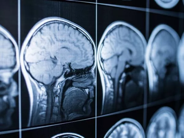 Cerebro