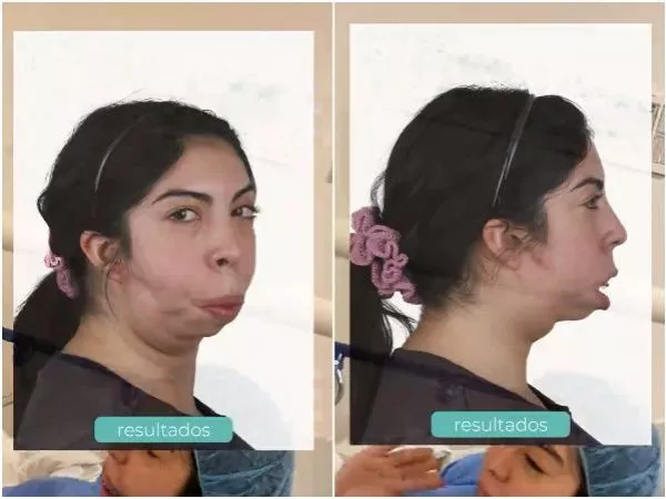 Joven con síndrome de Treacher Collins revela su antes y después