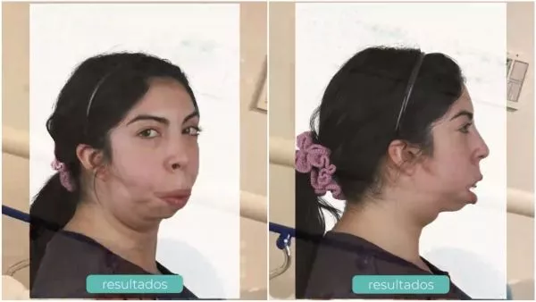 Joven con síndrome de Treacher Collins revela su antes y después