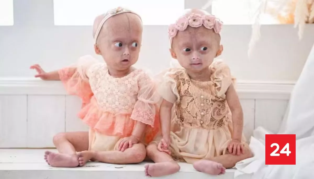 Muere Elis Lima Carneiro, la gemela brasileña de cinco años que visibilizó la progeria en redes sociales