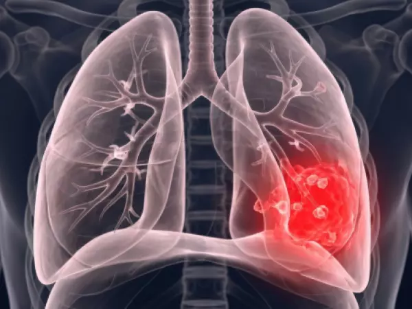 CÁNCER DE PULMÓN